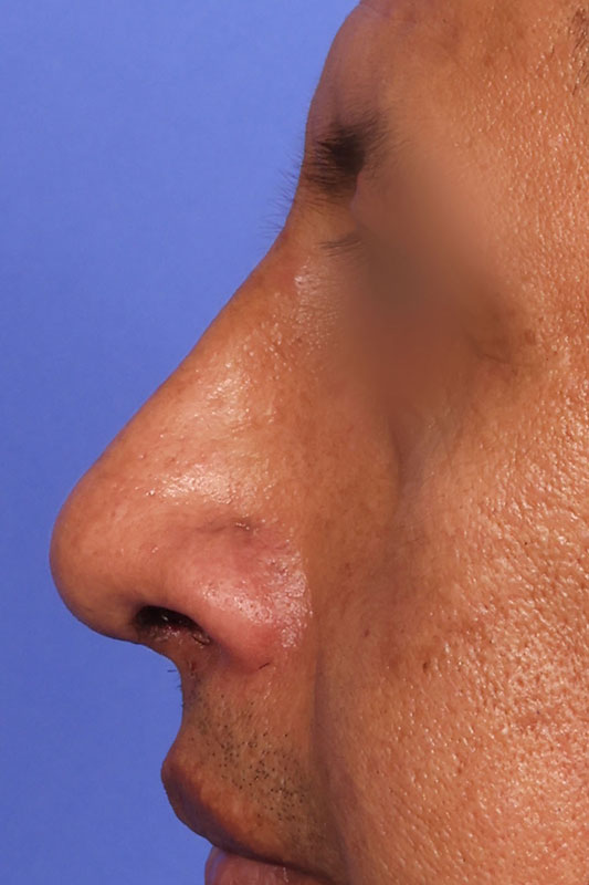 Rhinoplasty Before & After Image