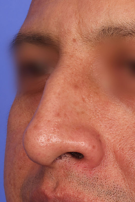 Rhinoplasty Before & After Image