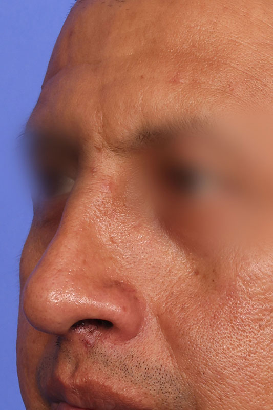 Rhinoplasty Before & After Image