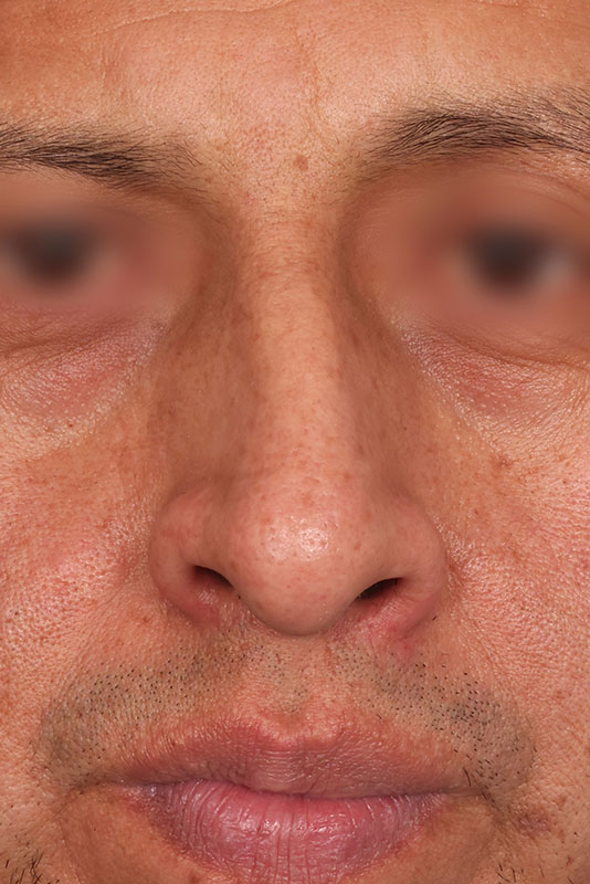 Rhinoplasty Before & After Image
