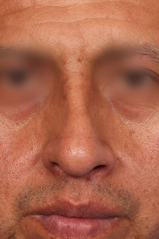 Rhinoplasty Before & After Image