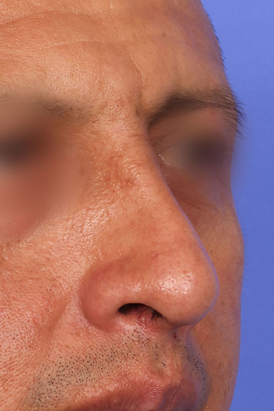 Rhinoplasty Before & After Image