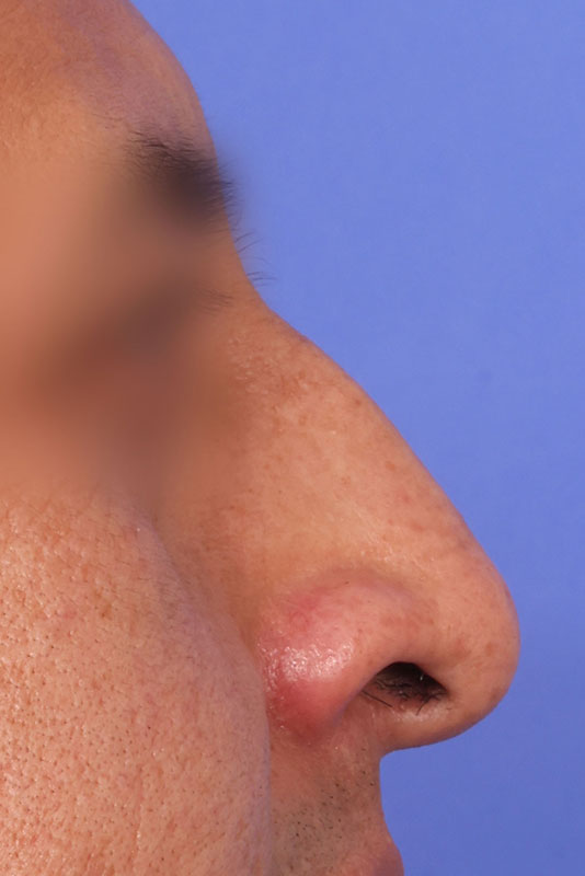 Rhinoplasty Before & After Image