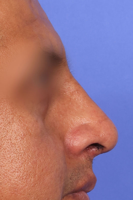 Rhinoplasty Before & After Image