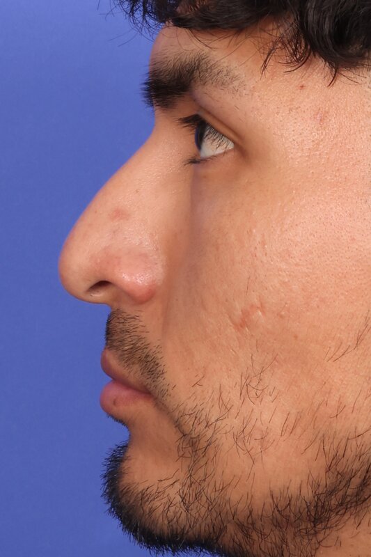 Rhinoplasty Before & After Image