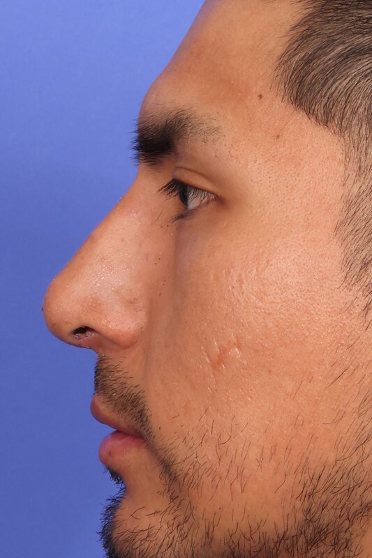 Rhinoplasty Before & After Image