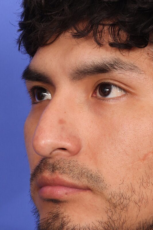 Rhinoplasty Before & After Image