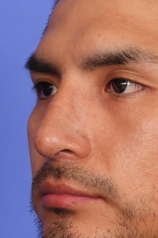 Rhinoplasty Before & After Image