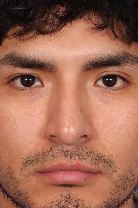 Rhinoplasty Before & After Image