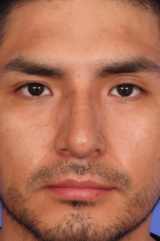 Rhinoplasty Before & After Image
