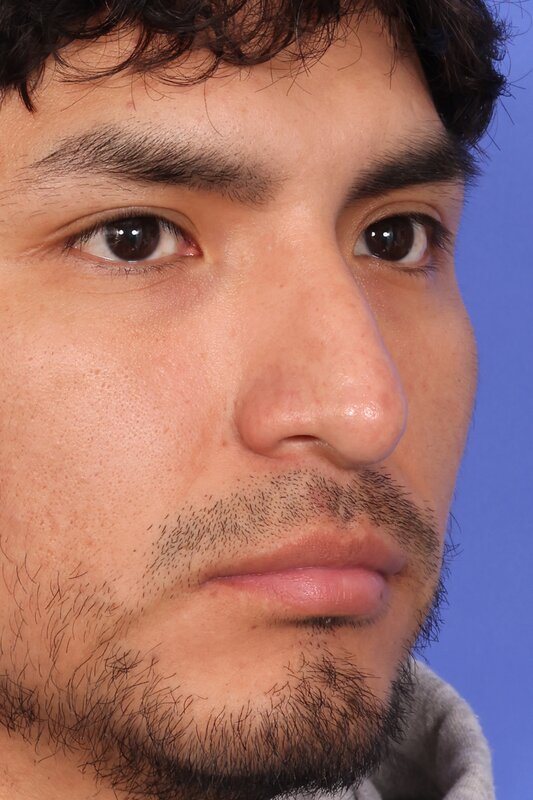 Rhinoplasty Before & After Image