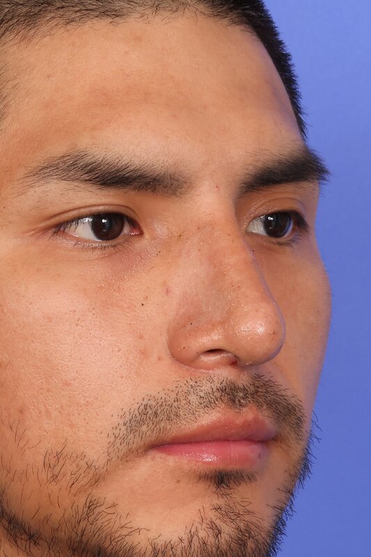 Rhinoplasty Before & After Image
