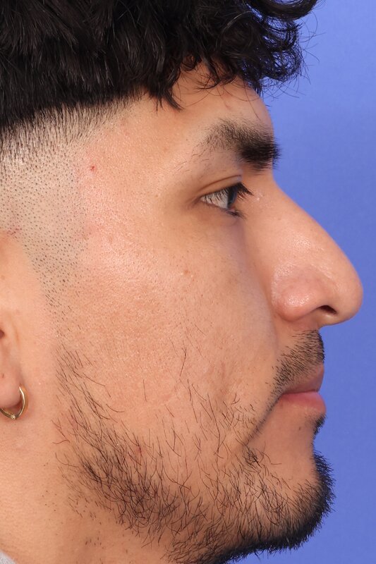 Rhinoplasty Before & After Image