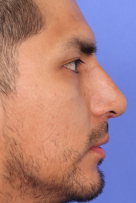 Rhinoplasty Before & After Image