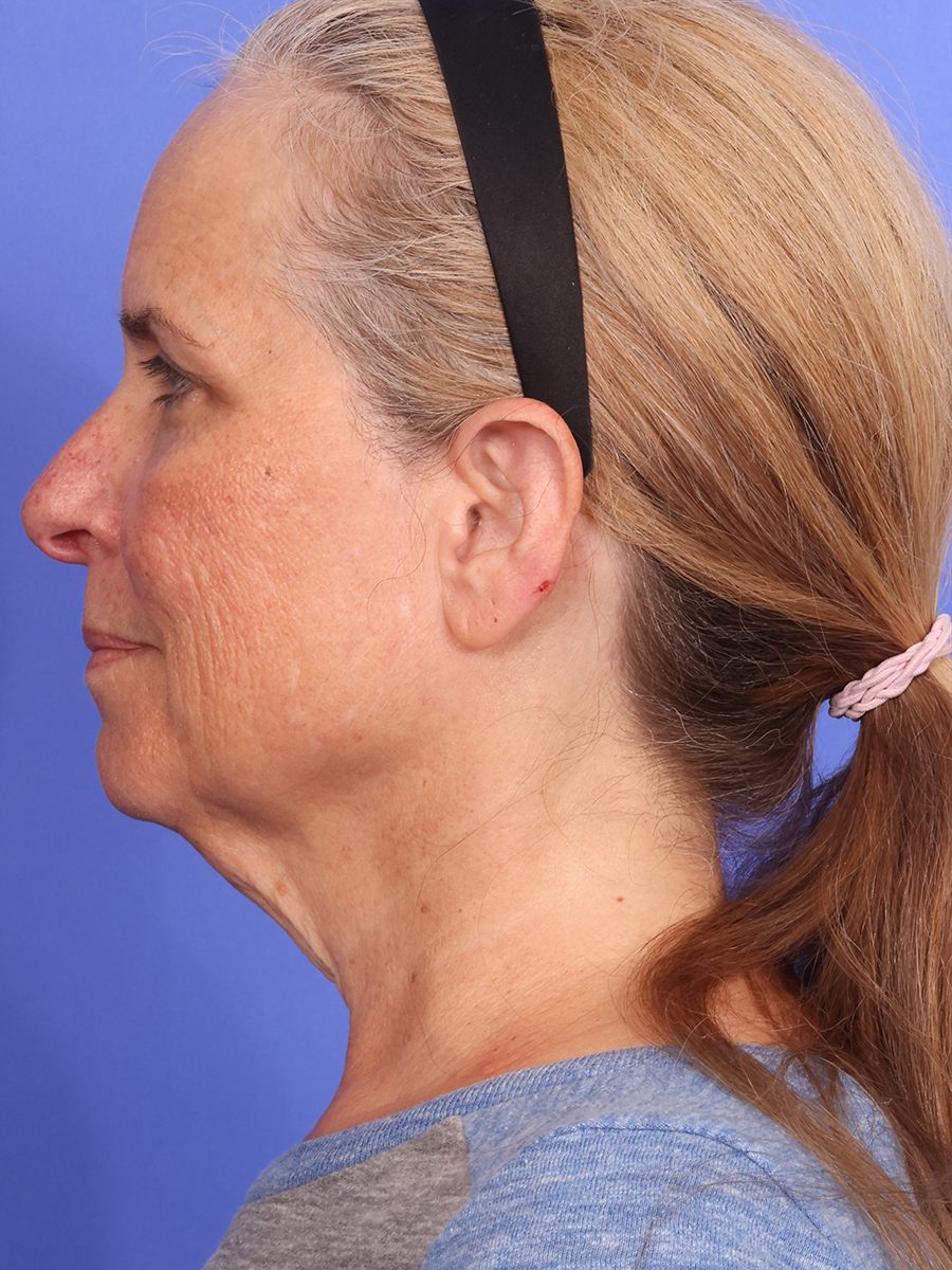 SAS Neck Lift Before & After Image