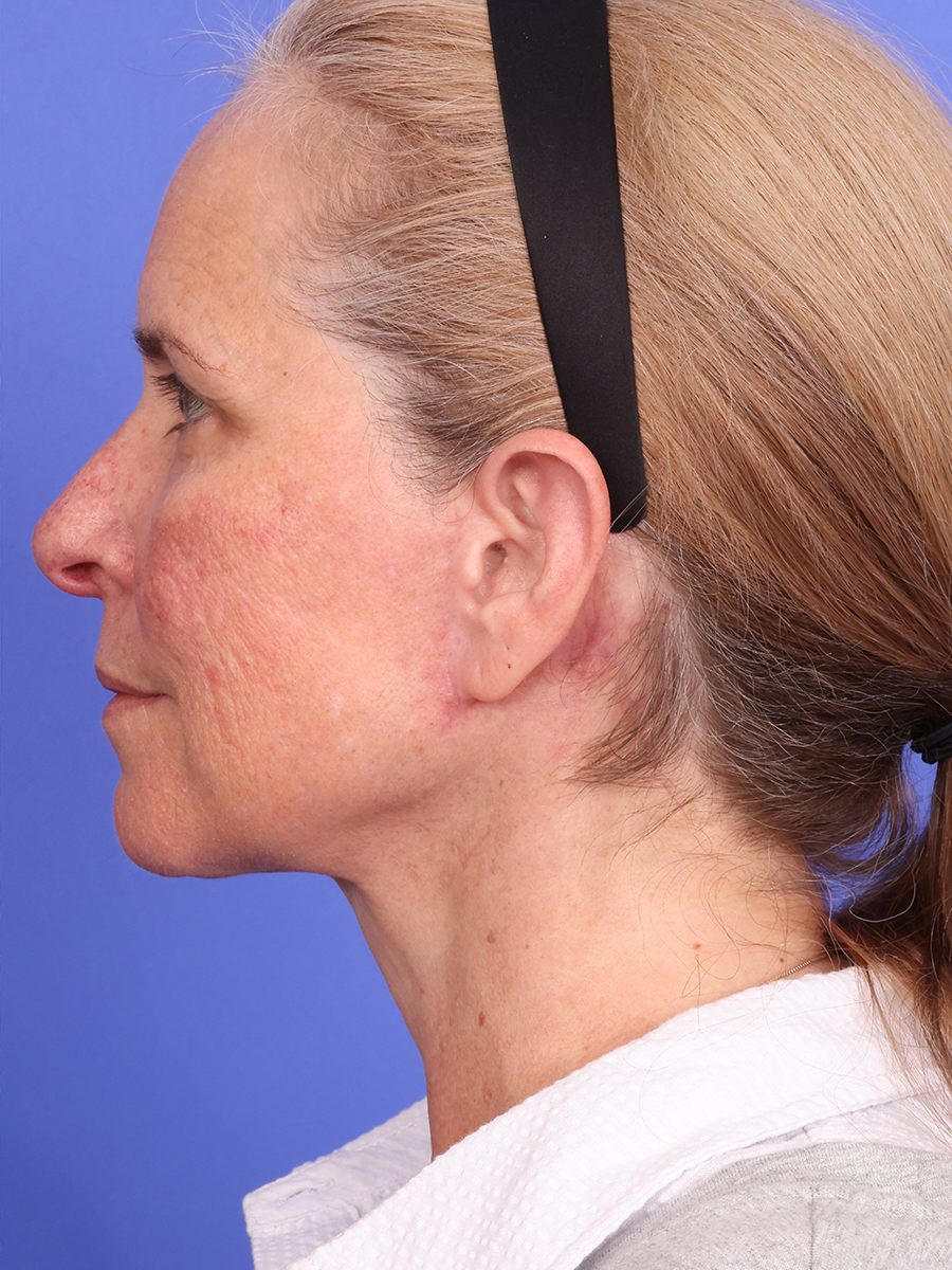 SAS Neck Lift Before & After Image
