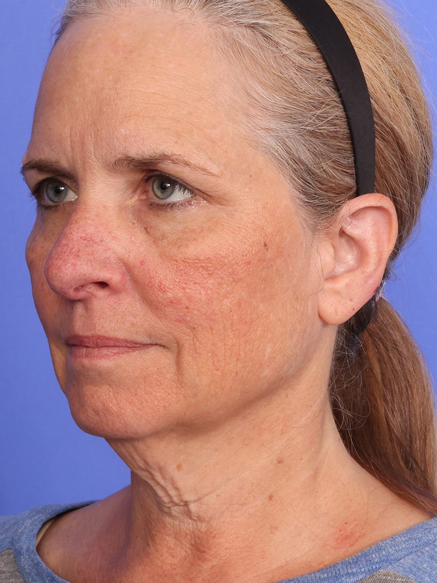 SAS Neck Lift Before & After Image