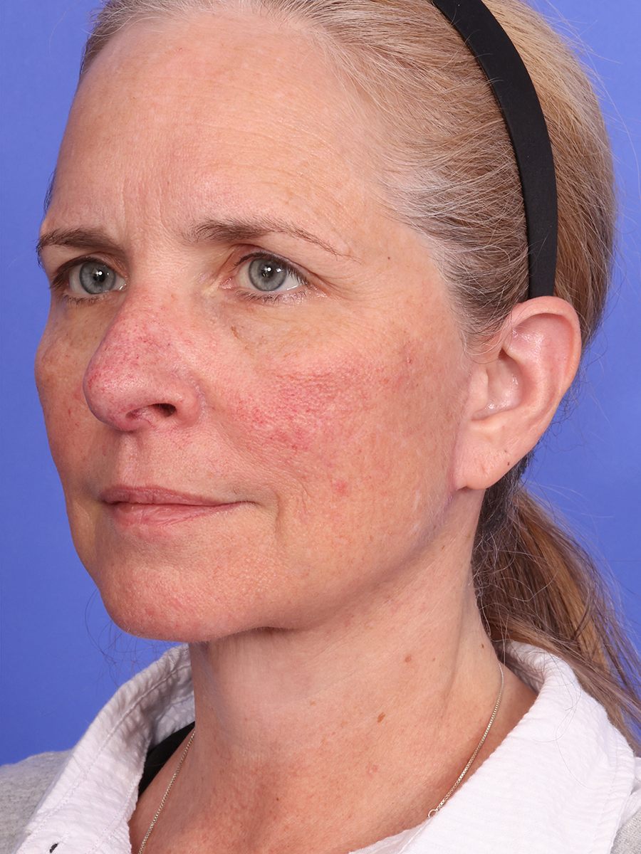 SAS Neck Lift Before & After Image