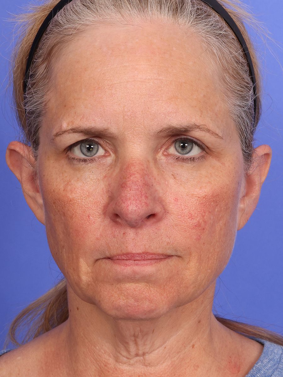 SAS Neck Lift Before & After Image