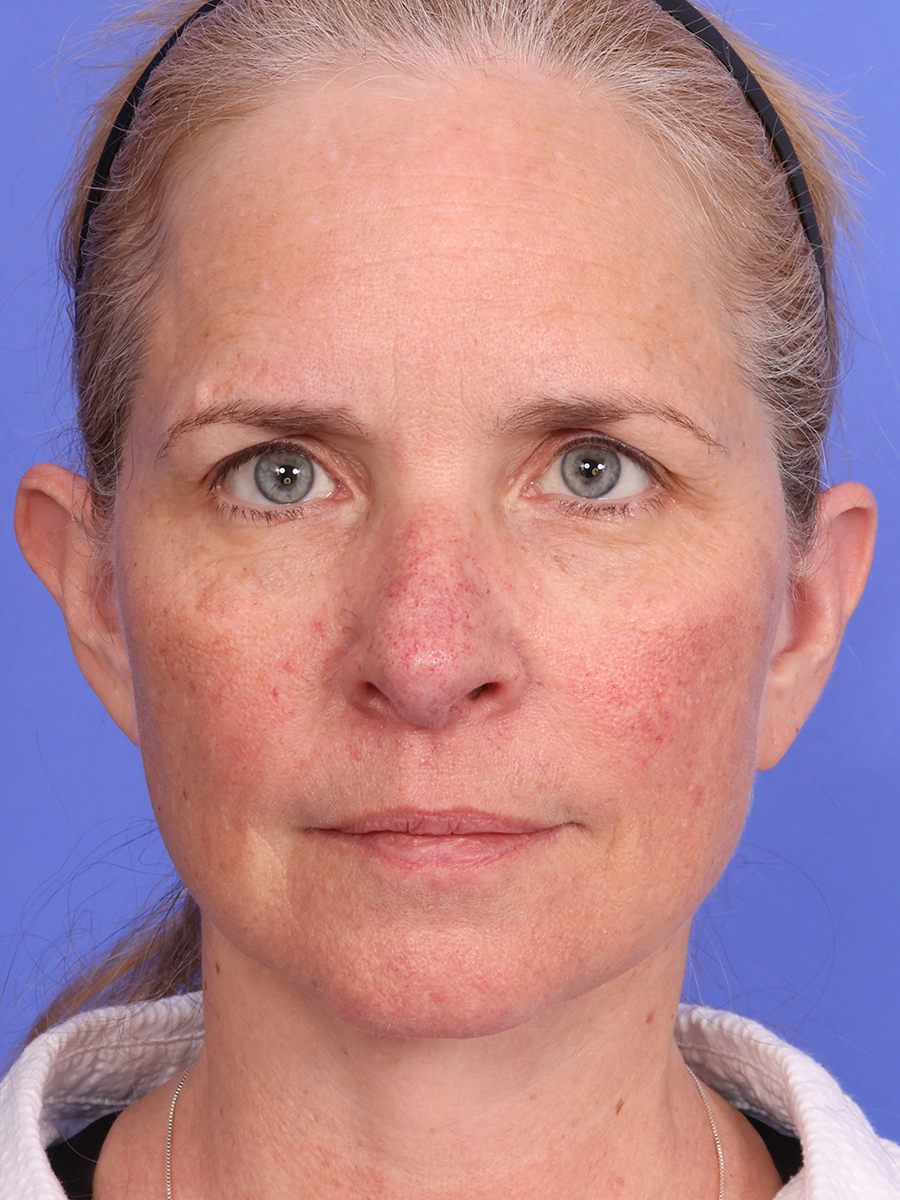 SAS Neck Lift Before & After Image