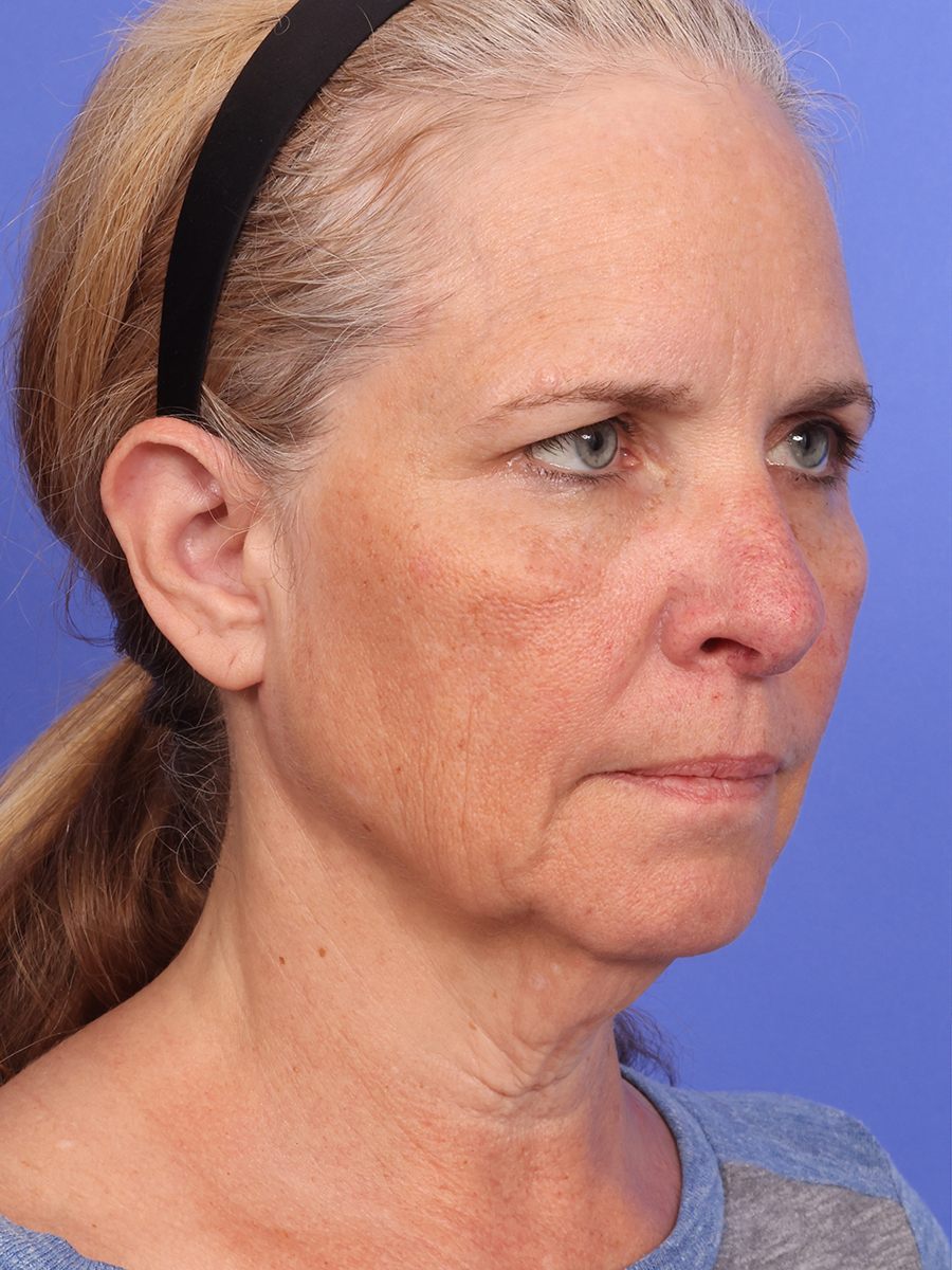 SAS Neck Lift Before & After Image