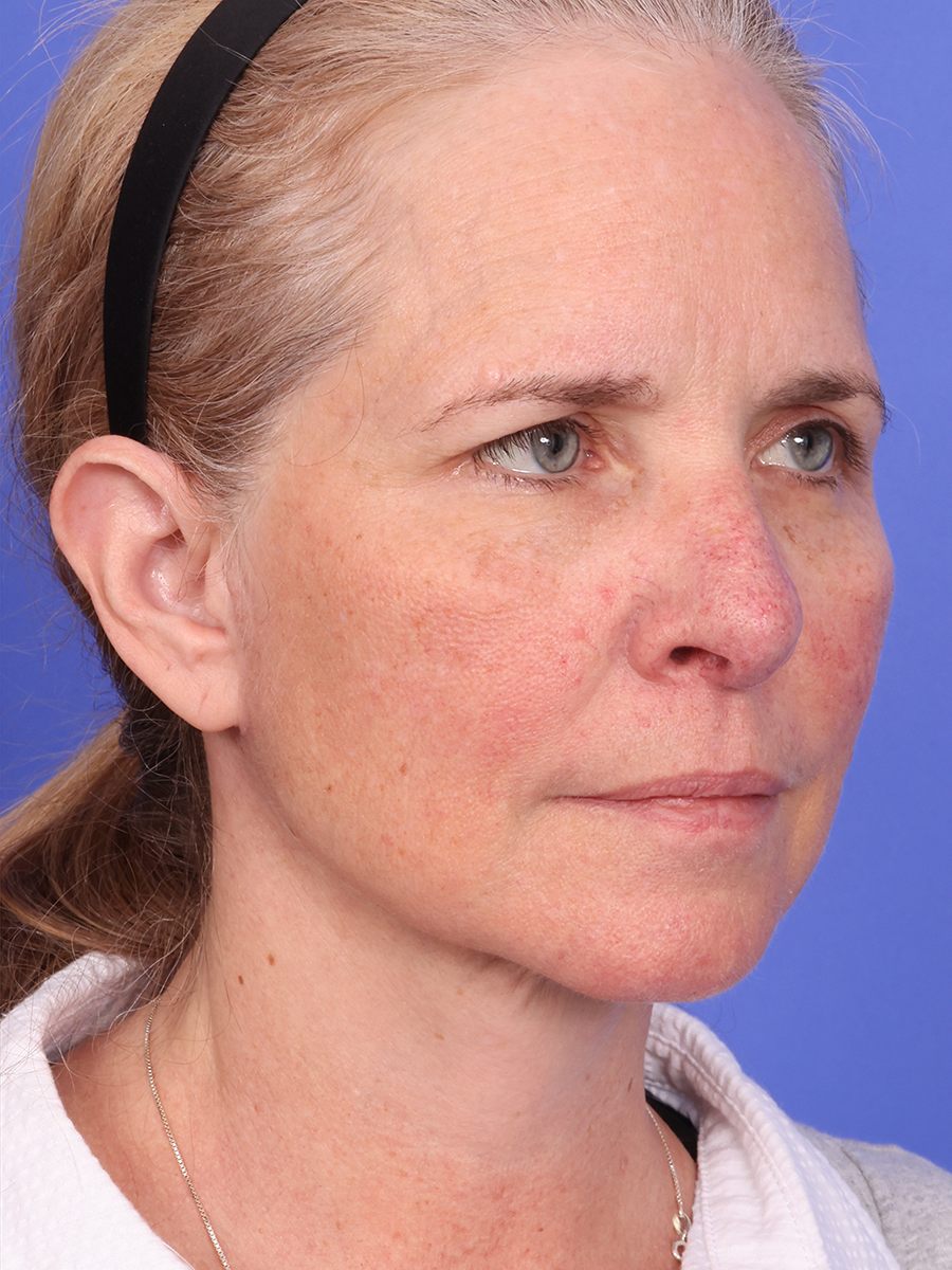 SAS Neck Lift Before & After Image