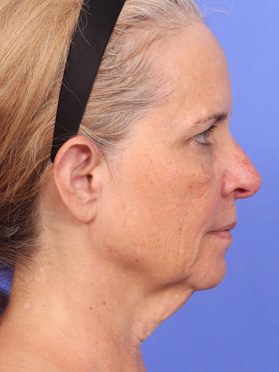 SAS Neck Lift Before & After Image