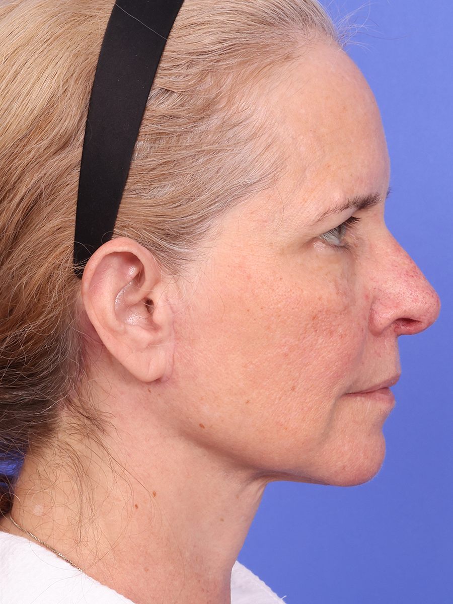 SAS Neck Lift Before & After Image
