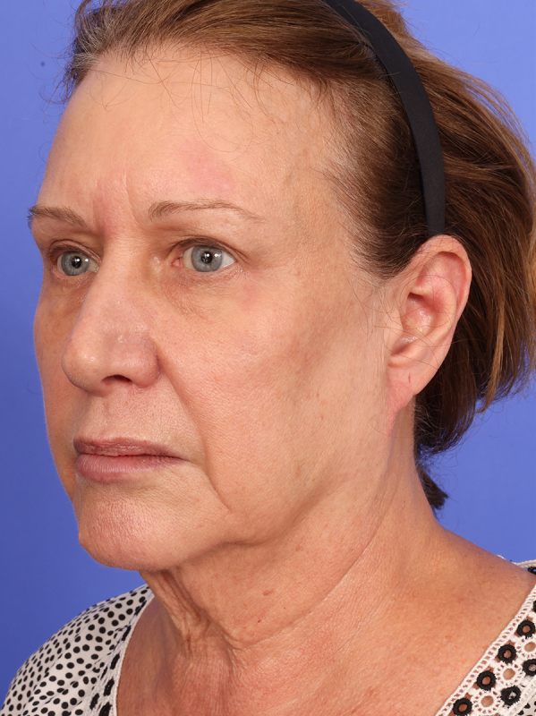 SAS Neck Lift Before & After Image