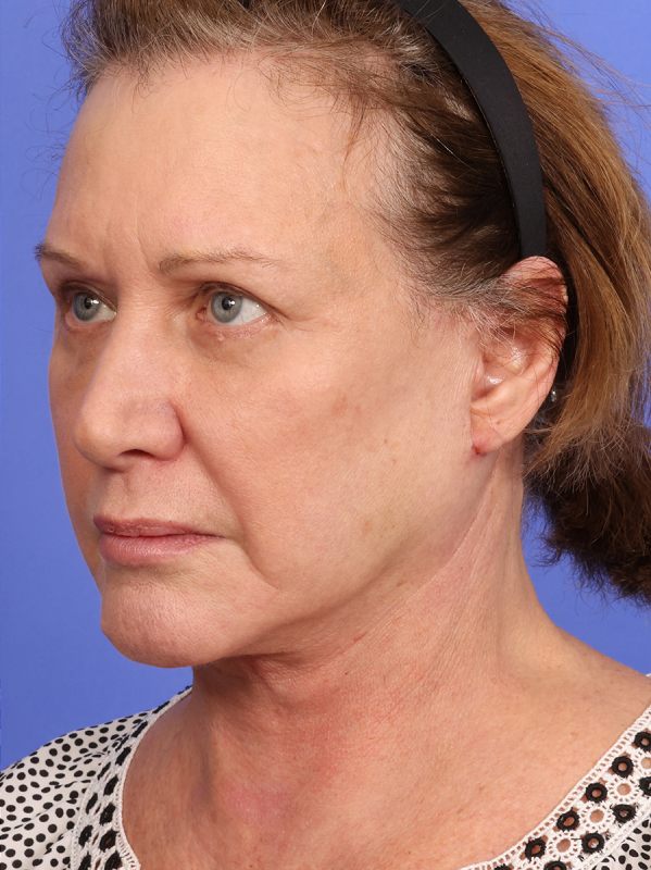 SAS Neck Lift Before & After Image