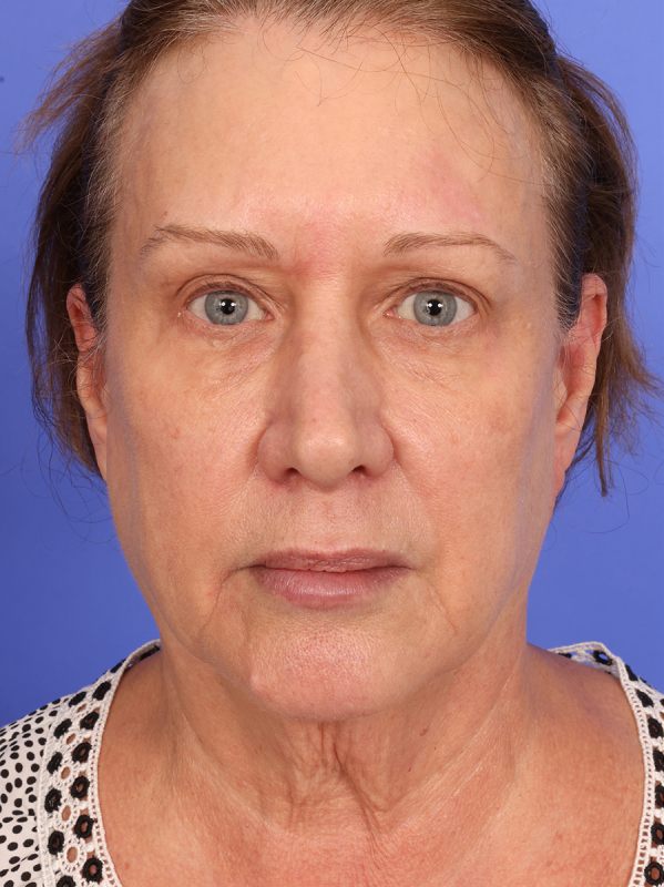 SAS Neck Lift Before & After Image