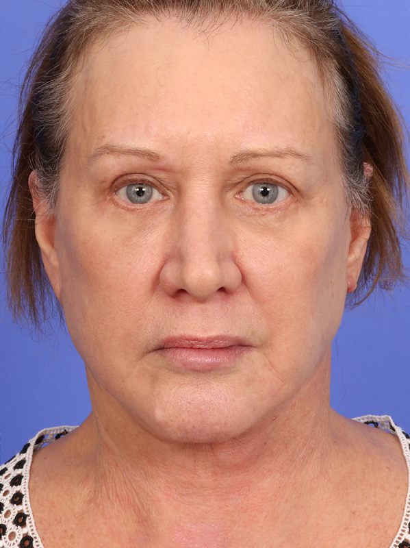 SAS Neck Lift Before & After Image