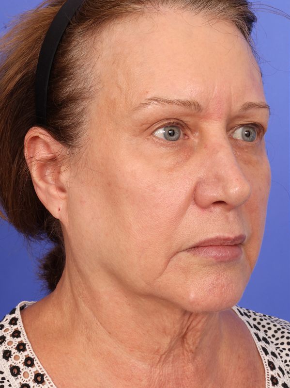 SAS Neck Lift Before & After Image