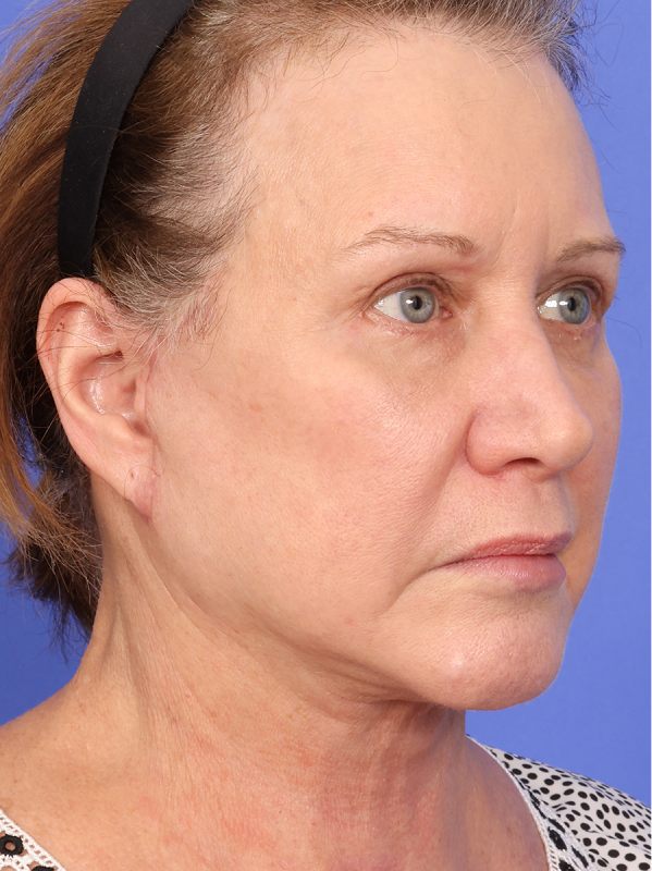 SAS Neck Lift Before & After Image