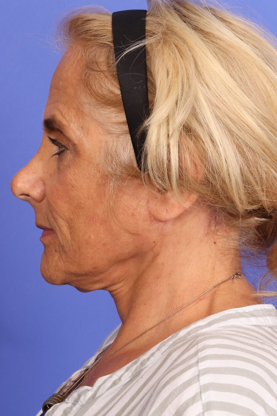 SAS Neck Lift Before & After Image