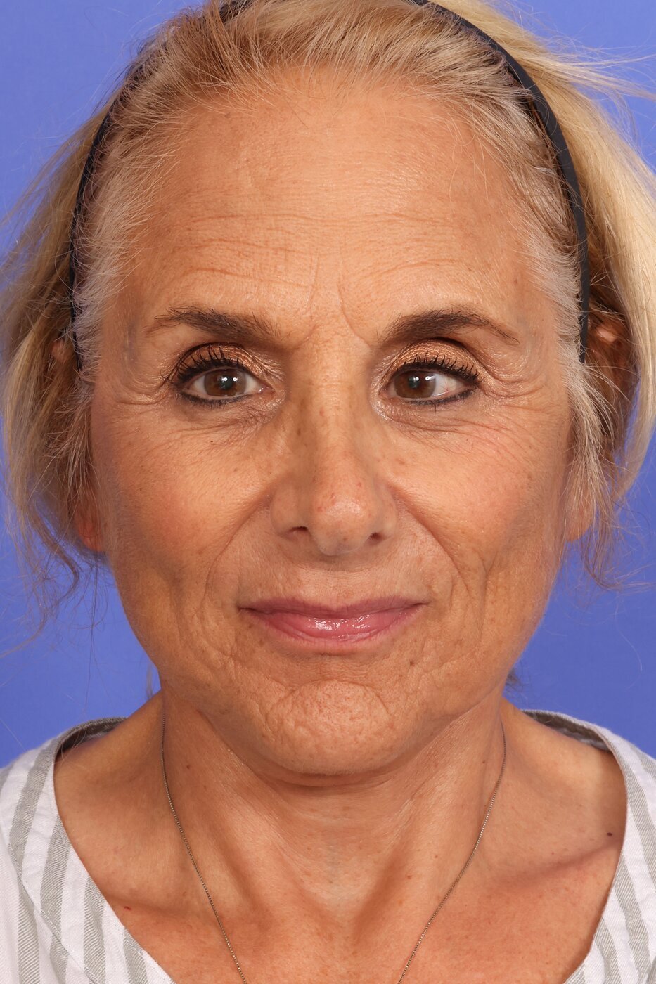 SAS Neck Lift Before & After Image