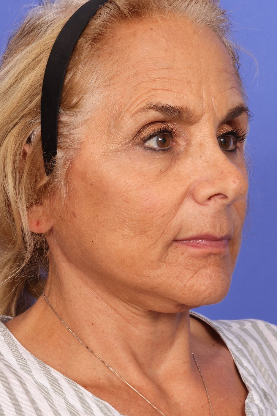 SAS Neck Lift Before & After Image