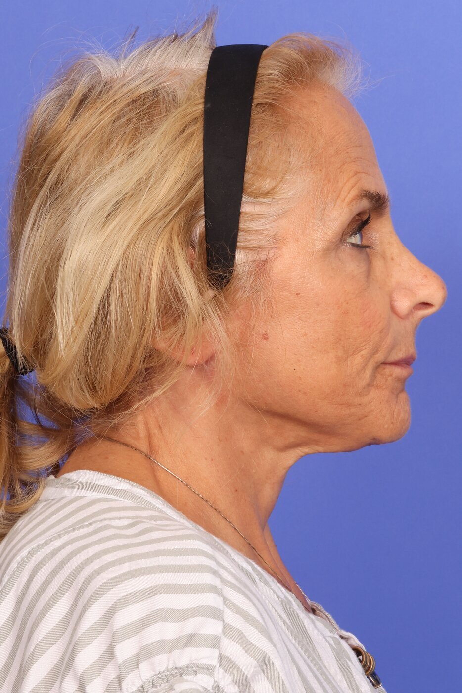 SAS Neck Lift Before & After Image