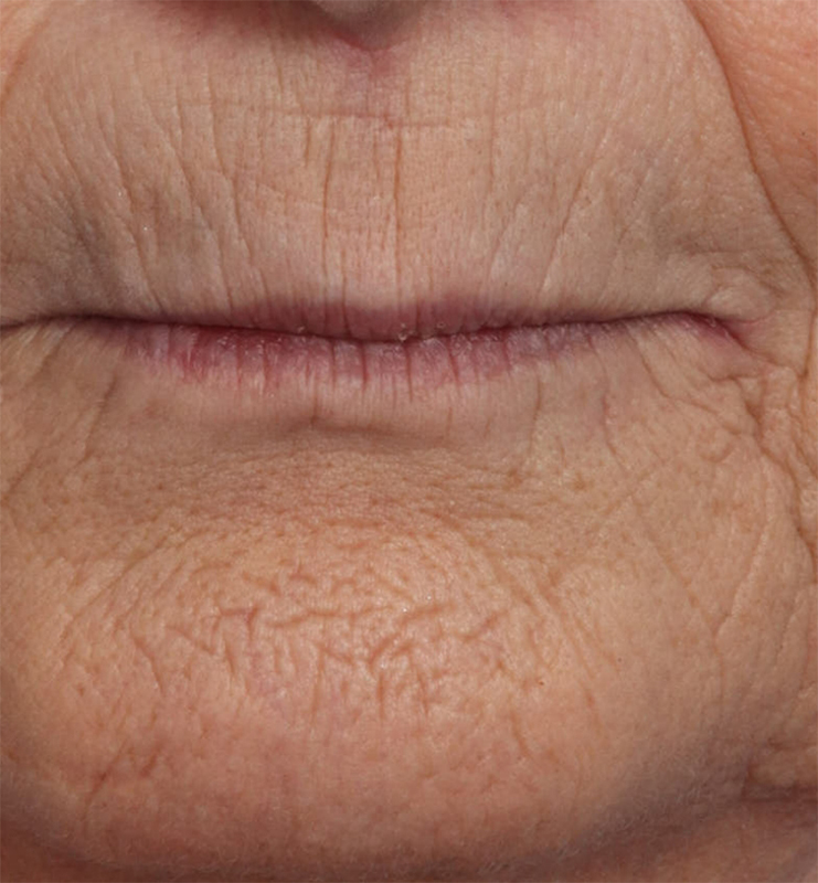 Skin Resurfacing Before & After Image