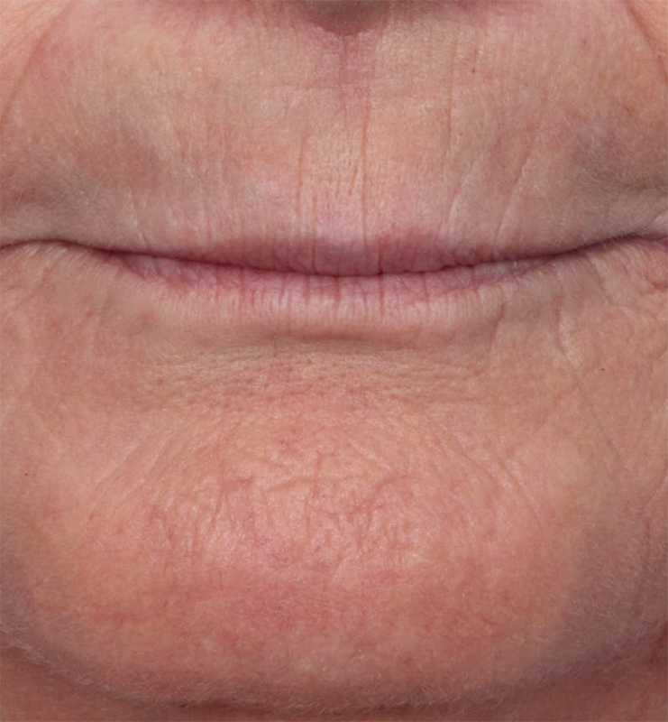 Skin Resurfacing Before & After Image