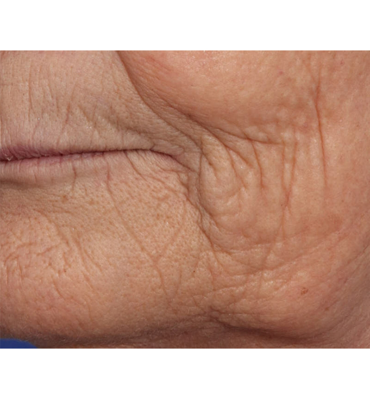 Skin Resurfacing Before & After Image