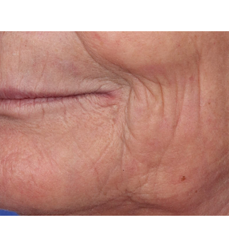 Skin Resurfacing Before & After Image