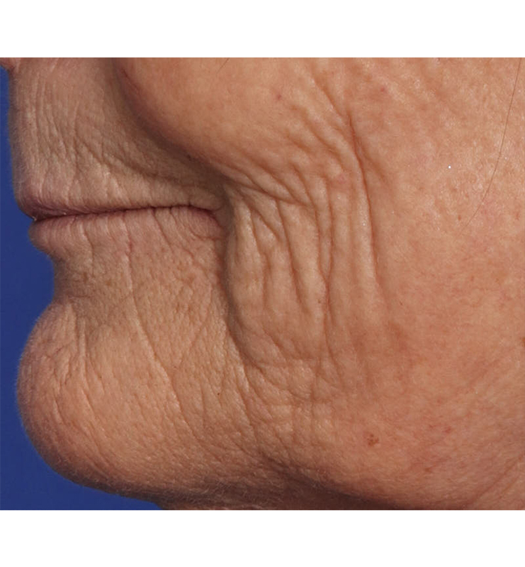 Skin Resurfacing Before & After Image