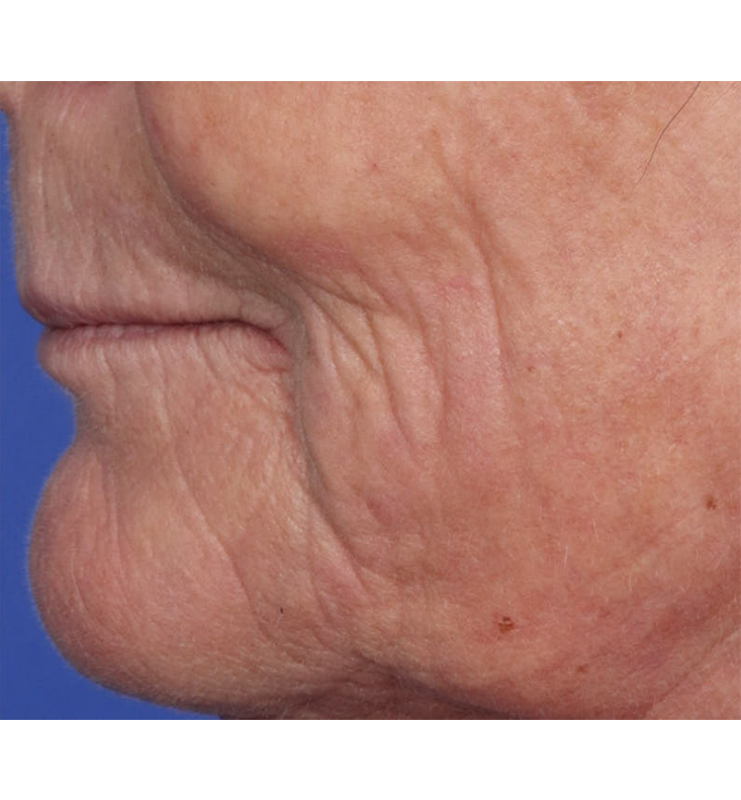 Skin Resurfacing Before & After Image