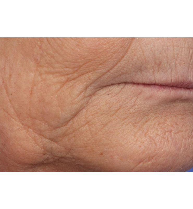 Skin Resurfacing Before & After Image