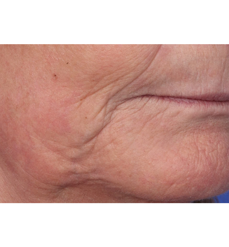 Skin Resurfacing Before & After Image