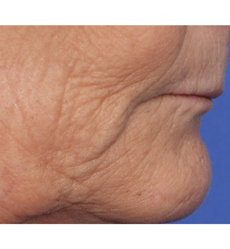 Skin Resurfacing Before & After Image