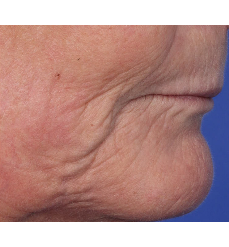 Skin Resurfacing Before & After Image