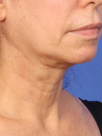 Skin Resurfacing Before & After Image