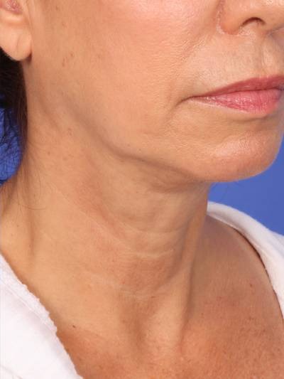 Skin Resurfacing Before & After Image